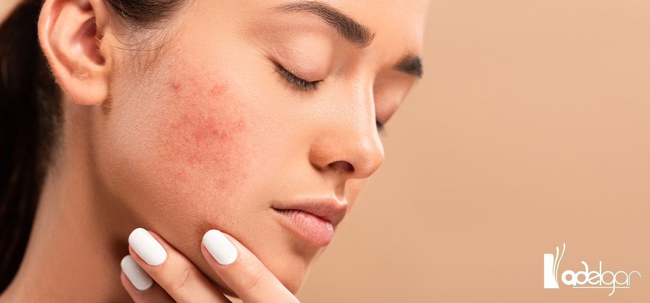 ¿Qué es Dermapen y qué beneficios tiene para tu piel? Clínica Adelgar