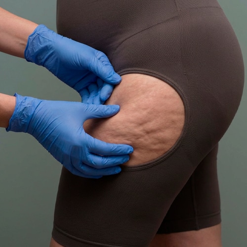 La celulitis y el lipedema son alteraciones del tejido subcutáneo que pueden afectar tanto al aspecto de la piel como al bienestar físico. | Adelgar, tu clínica de adelgazamiento, medicina y cirugía estética en Madrid.